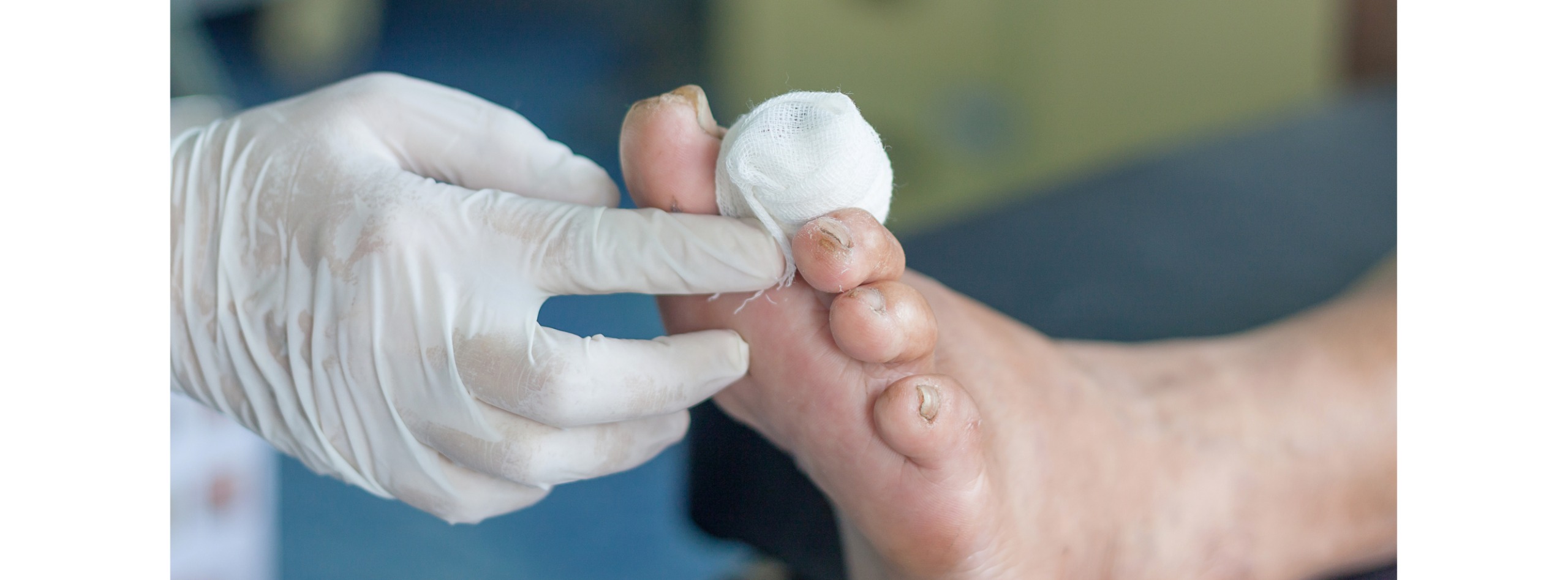 Varicose Treatment